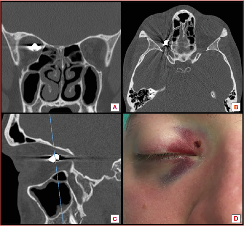 According to the CT scan, the bullet was located close to the optic nerve and the orbital apex (A: coronal, B: axial, C: sagittal views). A small wound related to the entry point of the bullet was present on the superior eyelid, close to the medial cantus of the right eye (D).