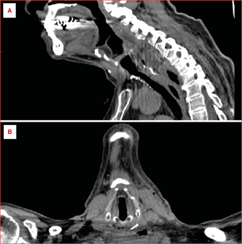 (A) Sagittal and (B) axial computed tomography with oral contrast agent of a patient with an uncontained hypopharyngeal perforation after open repair of Zenker diverticulum, demonstrating free extravasation of contrast agent outside the hypopharynx and postcricoid gas bubbles.