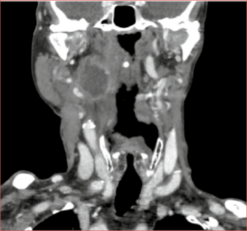 CT scan with contrast. Coronal view. Right parapharyngeal squamous cell carcinoma metastasis infiltrating the superior pharyngeal constrictor muscle.