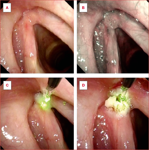 In-office treatment of papillomas. (A) pre-treatment endoscopic view in white light; (B) pre-treatment endoscopic view in NBI; (C) superficial blanching of the lesion; (D) laser tip is inserted to obtain its shrinkage and complete removal.