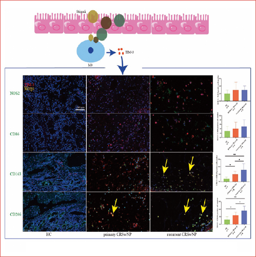 Increased TIM-3 expression levels in recurrent chronic rhinosinusitis with nasal polyps (CRSwNP) tissues. TIM-3-driven macrophage M2 polarisation may be a risk factor for postoperative recurrence of CRSwNP.