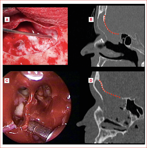 Two cases from the present series. A-B) Patient treated with combined endoscopic endonasal approach (EEA) and osteoplastic flap technique: A) An intraoperative detail at the end of the resection, revealing a defect in the posterior wall of the left frontal sinus, corresponding to the tumour’s insertion point; B) Preoperative radiological detail where the C-shaped conformation of the posterior wall of the frontal sinus is visible; C-D) Patient treated with exclusive EEA: C) Intraoperative detail at the end of resection, obtained through a Draf III procedure; the tumour insertion point resulted at the level of the frontal recess; D) Preoperative radiological detail where the straight conformation of the posterior wall of the frontal sinus is visible.