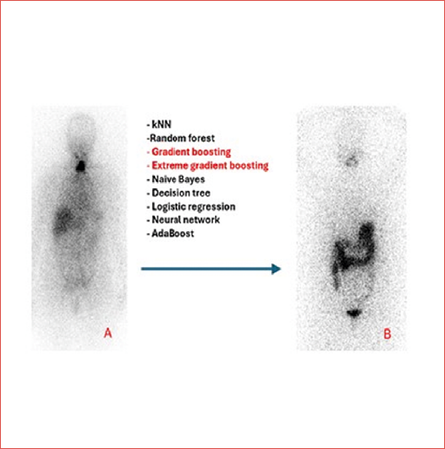 Predicting the success of radioidine therapy using machine learning (A: remnant thyroid tissue on the postablation scintigraphy; B: no remnant thyroid tissue on the control scintigraphy).