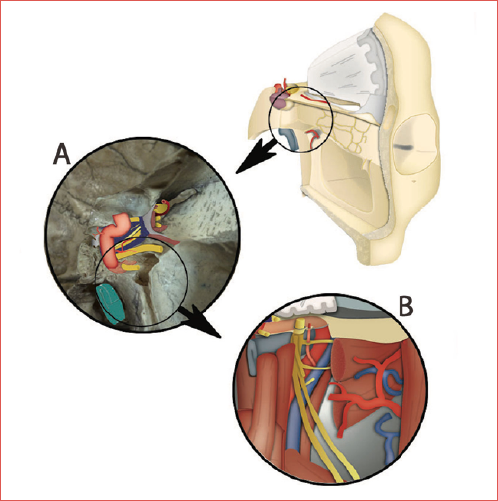 Schematic drawing showing surgical anatomy and steps for an extended exposure of infratemporal fossa, cavernous sinus and petro-clival regions.