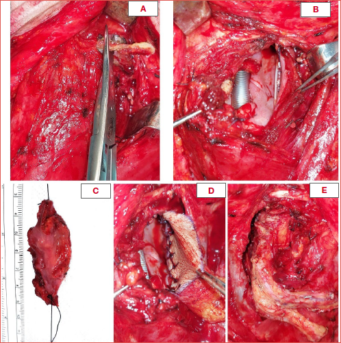 Left lateral hypopharyngectomy for recurrent T1 of the lateral wall of the piriform sinus after previous transoral surgery and CRT; A) Section of the left greater cornu of the hyoid bone; B) Defect to be reconstructed after tumour resection; C) Surgical specimen sent for histopathological examination (R0); D-E) Insetting of the radial forearm free flap used for reconstruction before its revascularisation on the left superior thyroid artery and vein.