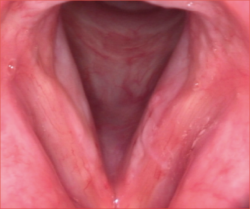 Endoscopic picture of the larynx showing signs of laryngopharyngeal reflux.