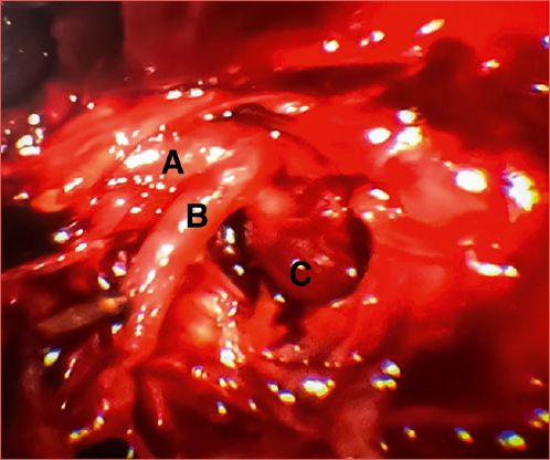 COVID-associated mucormycosis showing involvement of the left pterygopalatine fossa: A) sphenopalatine artery; B) greater palatine artery; C) internal maxillary artery.