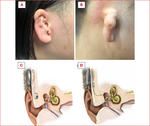 A) and B) patients affected by right congenital microtia and atresia; diagrams representing Bonebridge (C) and Vibrant Soundbridge (D) implants.