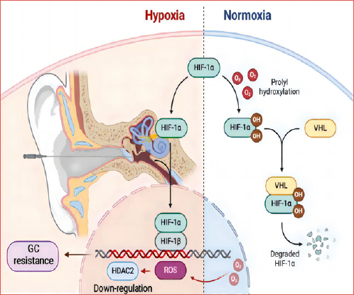 The activation of the hypoxia-inducible factor-1α inhibits histone deacetylase 2 expression in conditions of oxidative stress and results in the glucocorticoid resistance of refractory sudden sensorineural hearing loss.