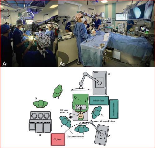 Schematic representation of transoral exoscopic laryngeal surgery setup. The exoscope is positioned on the right side of the first operator, while the CO2 laser is connected to the micromanipulator from the left side. The left figure depicts the surgical view of the first surgeon (A1), while the right one (A2) displays the arrangement of the operating room’s staff. (A) VITOM 3D exoscope equipped with the ARTipTM robotic cruise system; (B) ventilator; (C) HD-3D monitor; (D) laryngeal exposure system; (E) IMAGE 1 – Pilot; 1) main surgeon, 2) assistant surgeon, 3) anesthesiologist, 4) operatory room staff, 5) surgical nurse.