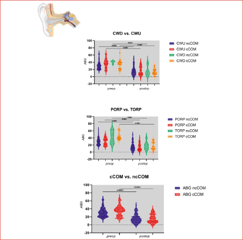 Comprehensive analysis of surgical interventions and hearing outcomes in chronic otitis media (COM). Our graphical cover illustrates the impact of various surgical approaches on hearing outcomes in patients with different tympanic membrane conditions, comparing COM with and without cholesteatoma while analysing preoperative and postoperative air-bone gap (ABG) outcomes for non-cholesteatomatous (ncCOM) and cholesteatomatous (cCOM) cases. Our findings highlight significant differences in hearing improvement between these groups and describe the effectiveness of partial ossicular reconstruction prosthesis (PORP) and total ossicular reconstruction prosthesis (TORP) to address hearing loss across distinct middle ear pathologies, providing a comprehensive view of subgroup analysis.