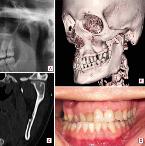 A) Left condylar osteochondroma on panoramic radiograph; B) CT 3D reconstruction; C) CT scan coronal view; D) dental occlusion with crossbite.