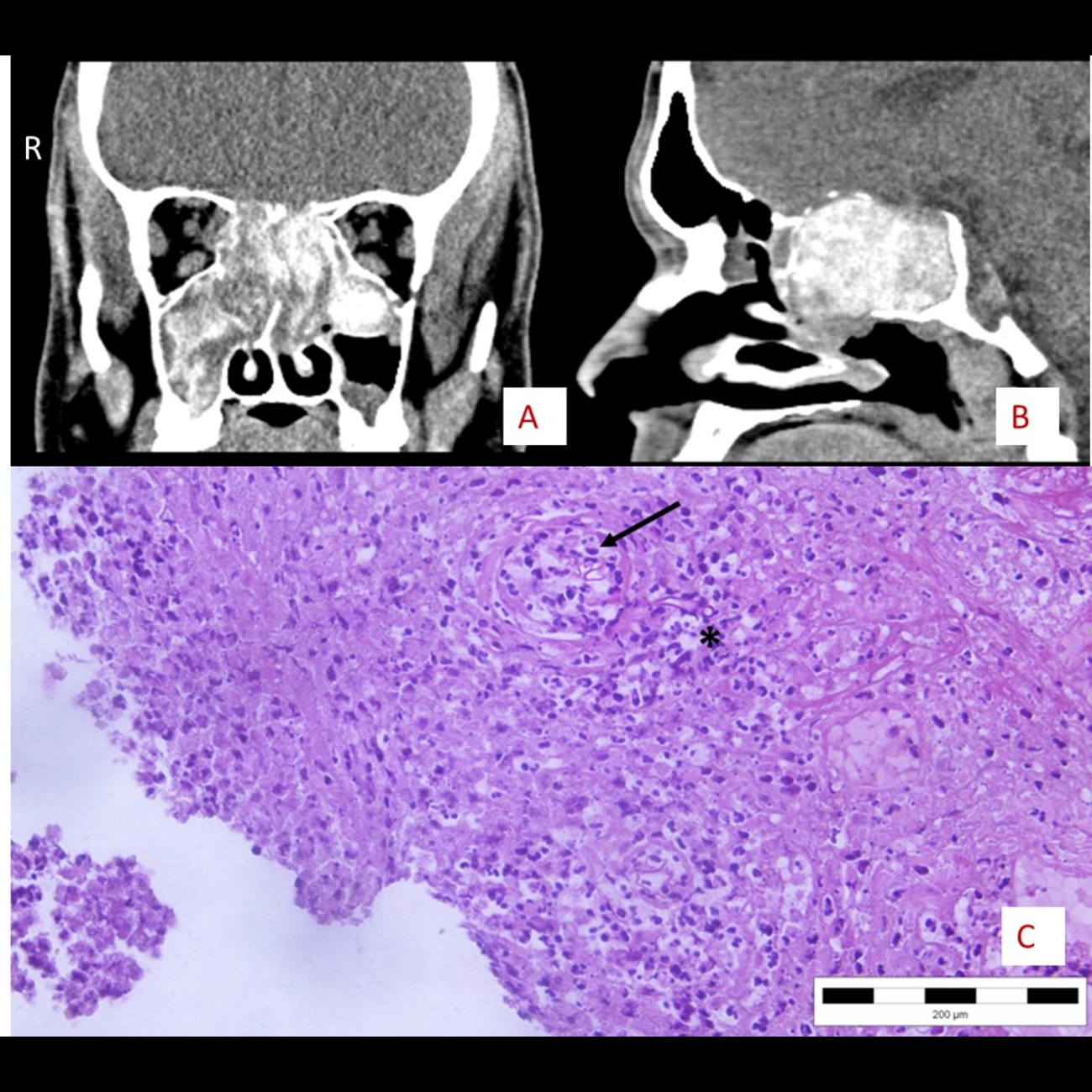 Radiological images of invasive fungal rhinosinusitis (A: coronal, B: sagittal views). Pathohistological image of fungal rhinosinusitis showing oedematous and partially necrotic nasal mucosa with a dilated blood vessel containing fungal elements (arrow) and inflammatory cells. Fungal elements are also seen in close proximity to the blood vessel (*). Haematoxylin and eosin stain, original magnification x200 (C).